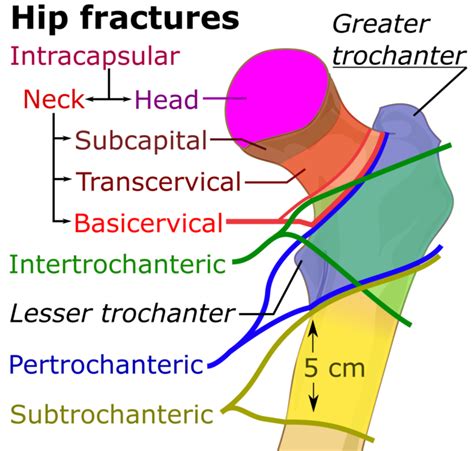 Femoral Neck Hip Fracture - Physiopedia