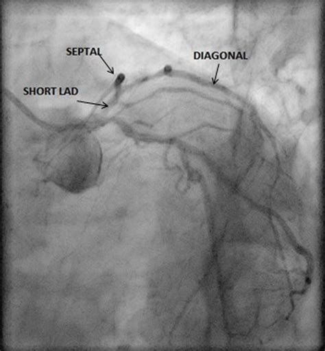 Four Major Coronary Arteries