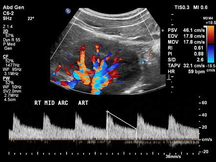 Buscar a tientas discreción Monótono renal artery duplex ultrasound ...