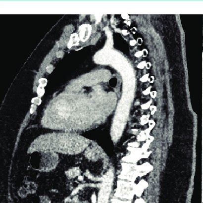 CT aortogram, sagittal view, on august 2020 shows a dramatic ...