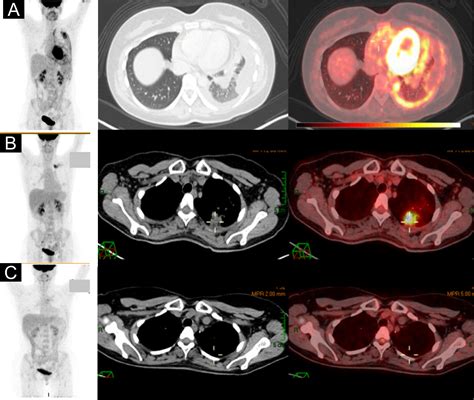 Frontiers | Case report: Osimertinib administration during pregnancy in ...