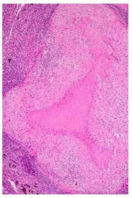 Biopsy revealing caseation necrosis | Download Scientific Diagram