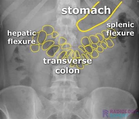 Abdominal X-ray