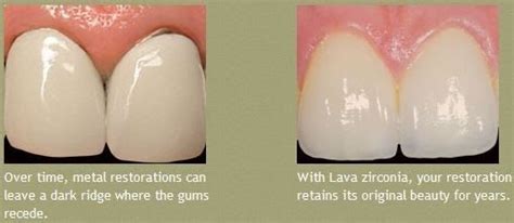 Perbedaan PFM vs Zirconia - Puri Dental Clinic