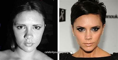 Celebrity Victoria Beckham before and after nose job - #Beckham # ...