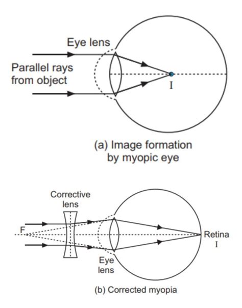 Explain myopia with the help of a ray diagram?