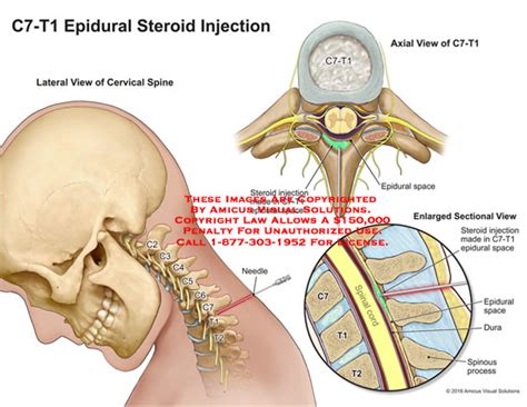 AMICUS Illustration of amicus,medical,injections,epidural,C7,T1,cervical,spine,steriod,space ...