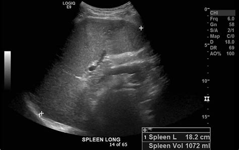 Incidental Diagnosis of Adult Beta-Thalassemia With Point-of-Care Ultrasound in the Emergency ...