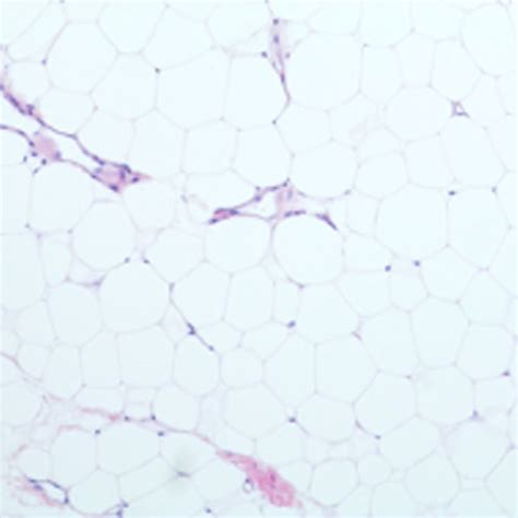 Histology slide demonstrating well-differentiated liposarcoma ...