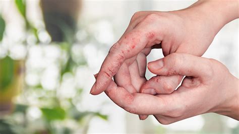 Eczema vs. Scabies: Symptoms and Photos - GoodRx