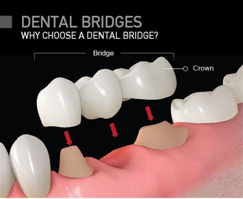 Dental Bridges vs. Single Tooth Implants - Eastport Dental AZ