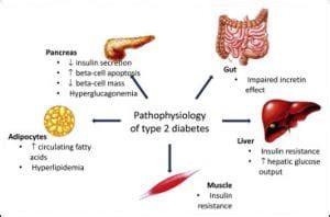 Pathophysiology | Diabetes Type 2