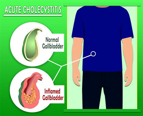 Acute Cholecystitis - Inflammation of the gallbladder Symptoms and Cause