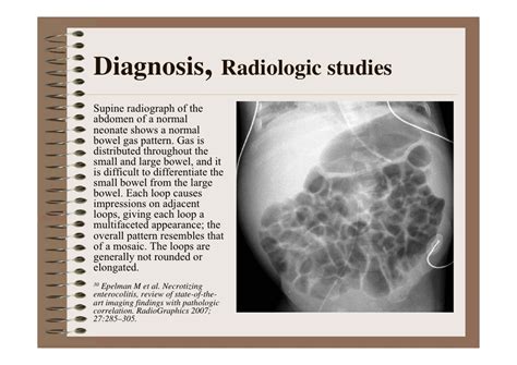 Necrotizing Enterocolitis