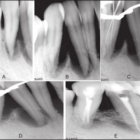 (A) Intraoral Periapical radiograph of 22. (B) Angulated radiograph of... | Download Scientific ...