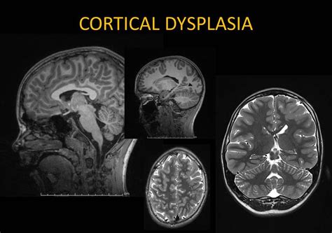 What Is Cortical Dysplasia? | EpilepsyU