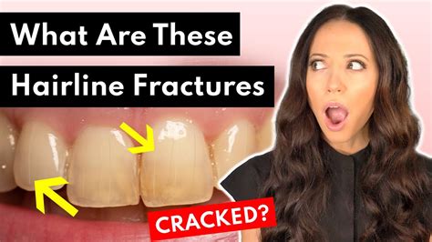 What are CRAZE LINES on Teeth & What to Do About Them - YouTube