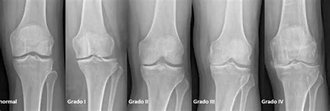 Osteoartritis de rodilla, ¿adiós a correr? | Readaptación lesiones | p53 estudio