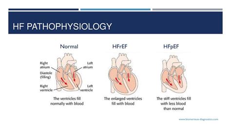 PPT - Heart failure with preserved ejection fraction ( HF p EF ) PowerPoint Presentation - ID ...