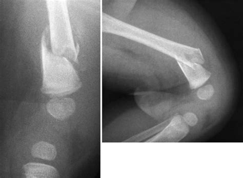 Children’s fractures | Musculoskeletal Key