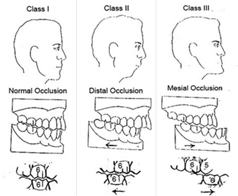 Retrognathism or retrognathia definition, causes, symptoms, diagnosis, treatment & prognosis