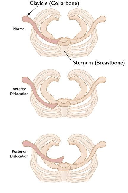 Sternoclavicular (SC) Joint Disorders - OrthoInfo - AAOS