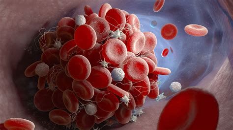 Why Clotting Happens When Platelets Are Low | MedPage Today