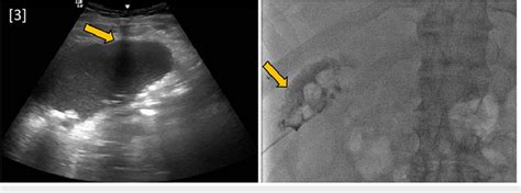 Fluoroscopic image-guided percutaneous cholecystostomy tube placement ...