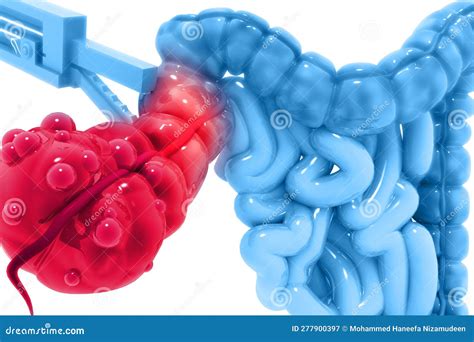 Appendix surgery stock illustration. Illustration of equipment - 277900397