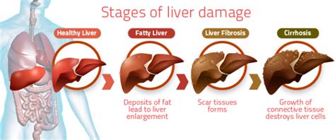 Fatty Liver Diet Do's And Don'ts