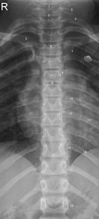 Normal Thoracic X Ray