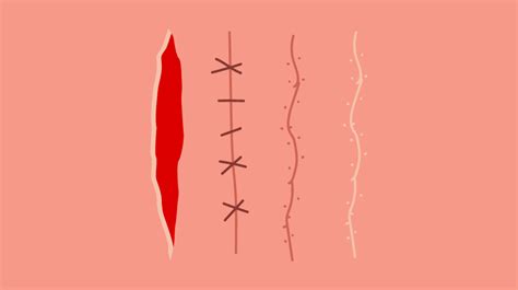 What is Scar Tissue? Does it contribute to pelvic pain?