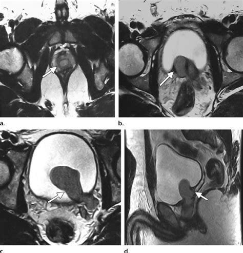 Ureterocele with hydroureter mimicking a prostatic cyst in a ...