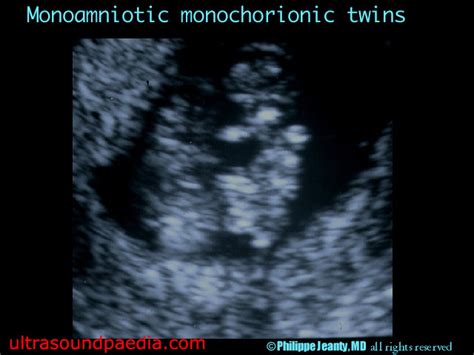 Monochorionic twins – ULTRASOUNDPAEDIA