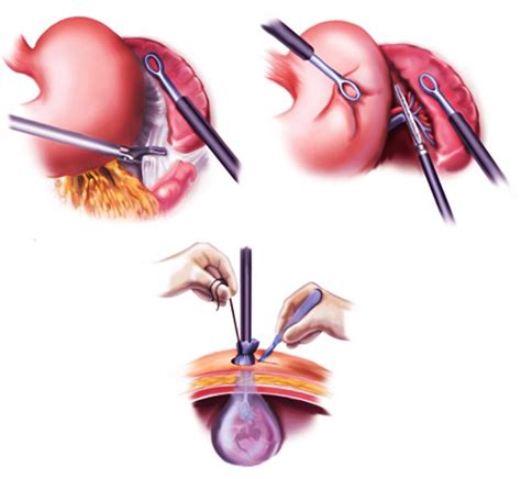 Splenectomy Perth | Surgical Removal of The Spleen | Spleen Removal