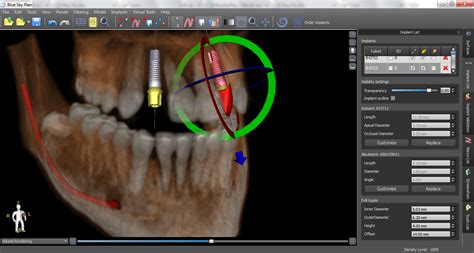 Guided Implants Treatment Planning Software Blue Sky Plan | Blue Sky ...