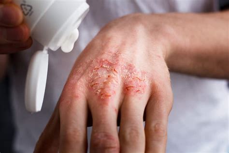 The Best Treatment And Home Remedies For Eczema