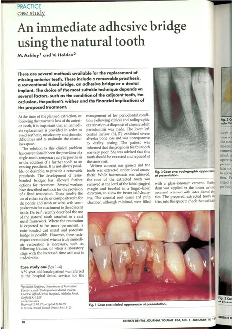 (PDF) An immediate adhesive bridge using the natural tooth