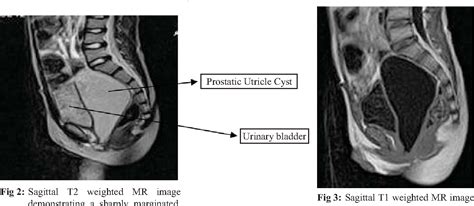 Figure 1 from Unusually large prostatic utricle cyst. | Semantic Scholar