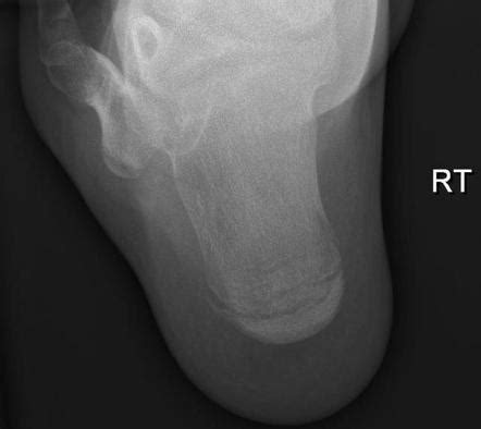 Normal axial calcaneal radiograph | Radiology Case | Radiopaedia.org