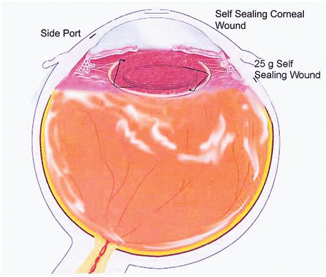 Schematic representation of the eye at the end of the surgery. Note the ...