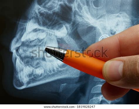 1 Adolescent Dental Trauma Images, Stock Photos, 3D objects, & Vectors ...