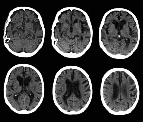 High Levels Of This Tap Water Element Could Help Prevent Dementia - CB ...