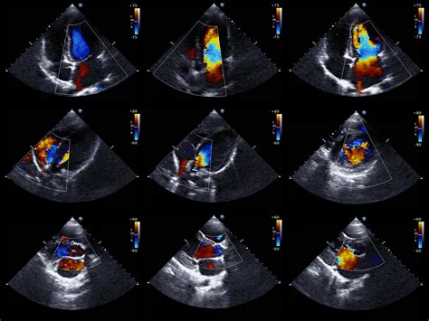 Cardiac Abnormalities in Children With HIV From HIV-Related Heart ...