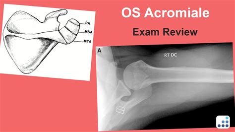 OS Acromiale Exam Review - Jay Keener, MD - YouTube