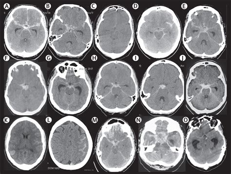 Traumatic Subarachnoid Hemorrhage