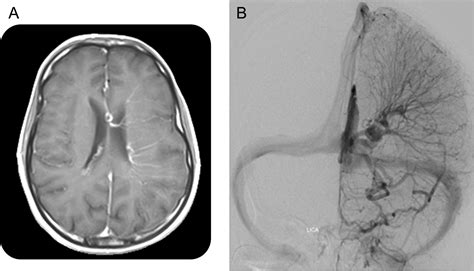 Teaching NeuroImages: A giant developmental venous anomaly in the absence of a superficial ...