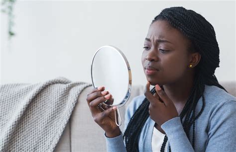 Acne: Considerations for darker skin - Harvard Health