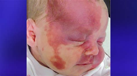 YOUR HEALTH: Treating port-wine birthmarks at a much earlier age | wqad.com