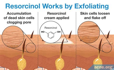 Resorcinol - Everything You Need to Know - Acne.org